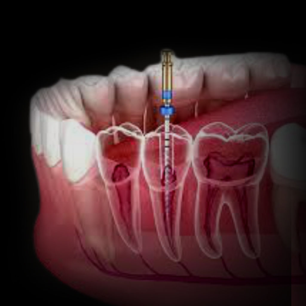 Endodontia - Dra. Elisama França