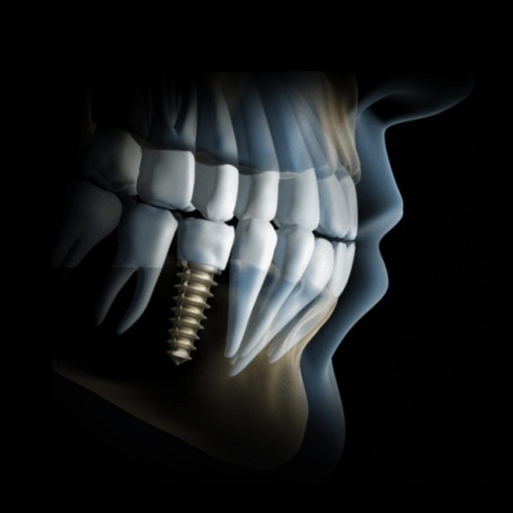 Implantes Dentários - Dra. Elisama França